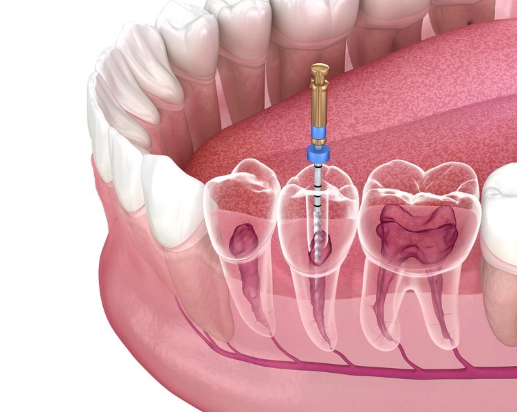 root canal treatment